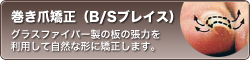 巻き爪矯正（B/Sブレイス） グラスファイバー製の板の張力を利用して自然な形に矯正します。